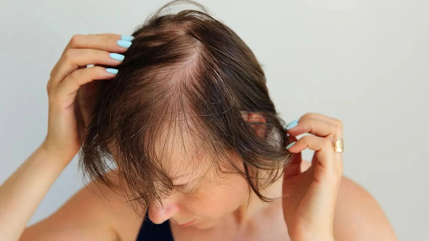 hair loss